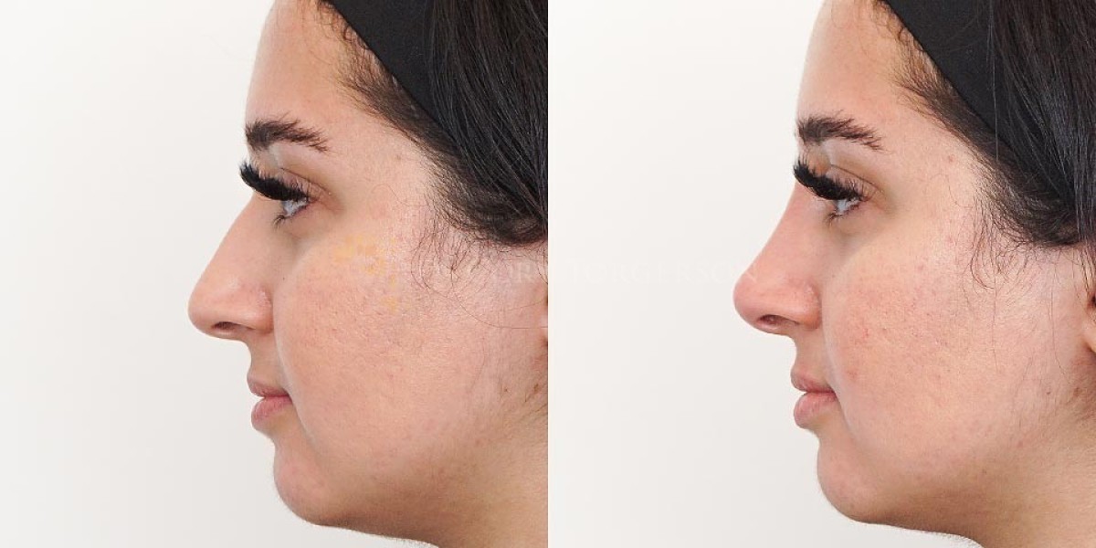 How to Choose the Best Filler for a Non-Surgical Nose Job