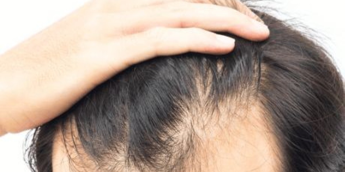 Aftercare Essentials Following a Hair Transplant in Sharjah