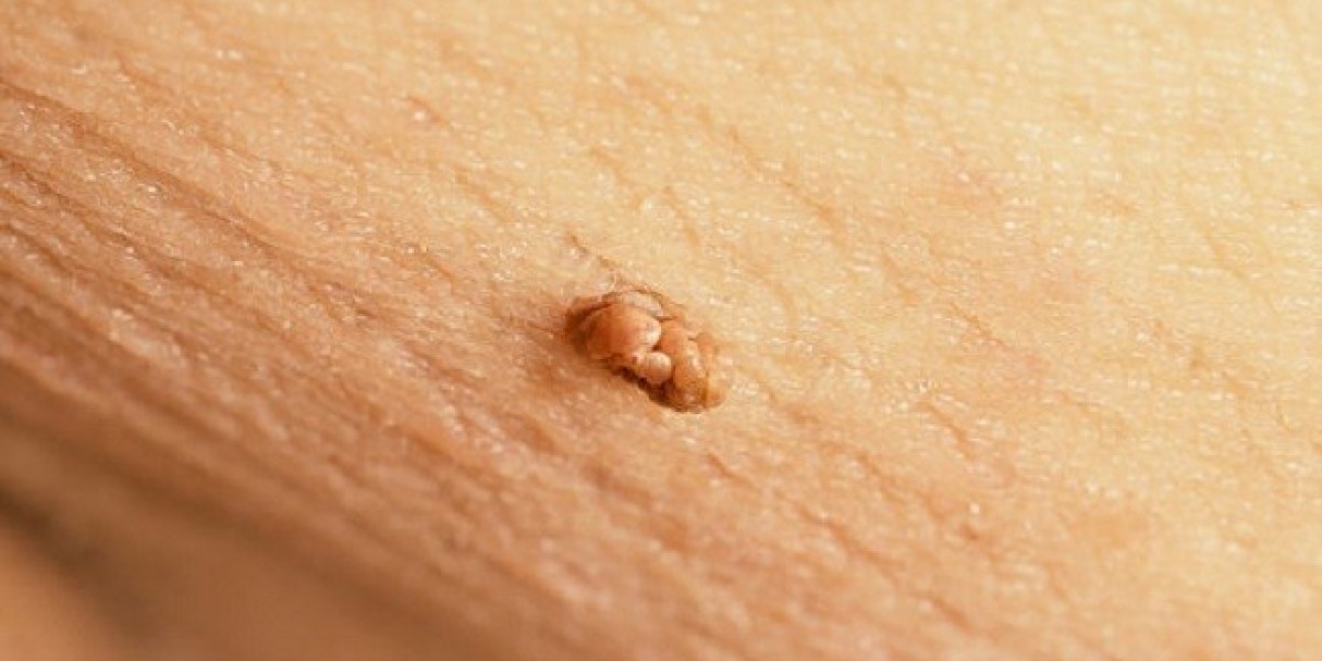 Skin Tag Removal: Best Treatment for Face & Neck