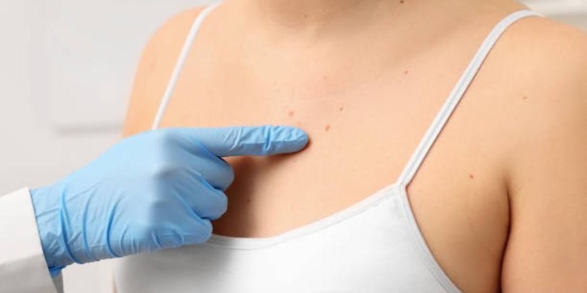 Can mole removal cream cause skin irritation or burns?