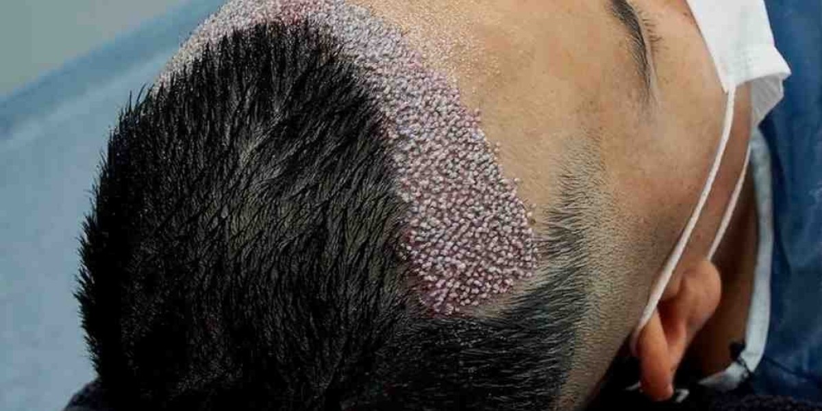 How Effective Is FUE Hair Transplant in Islamabad?