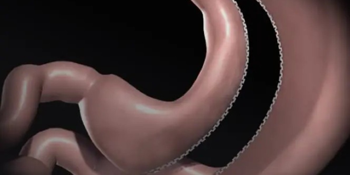 Is Gastric Sleeve Surgery a Permanent Solution for Obesity?