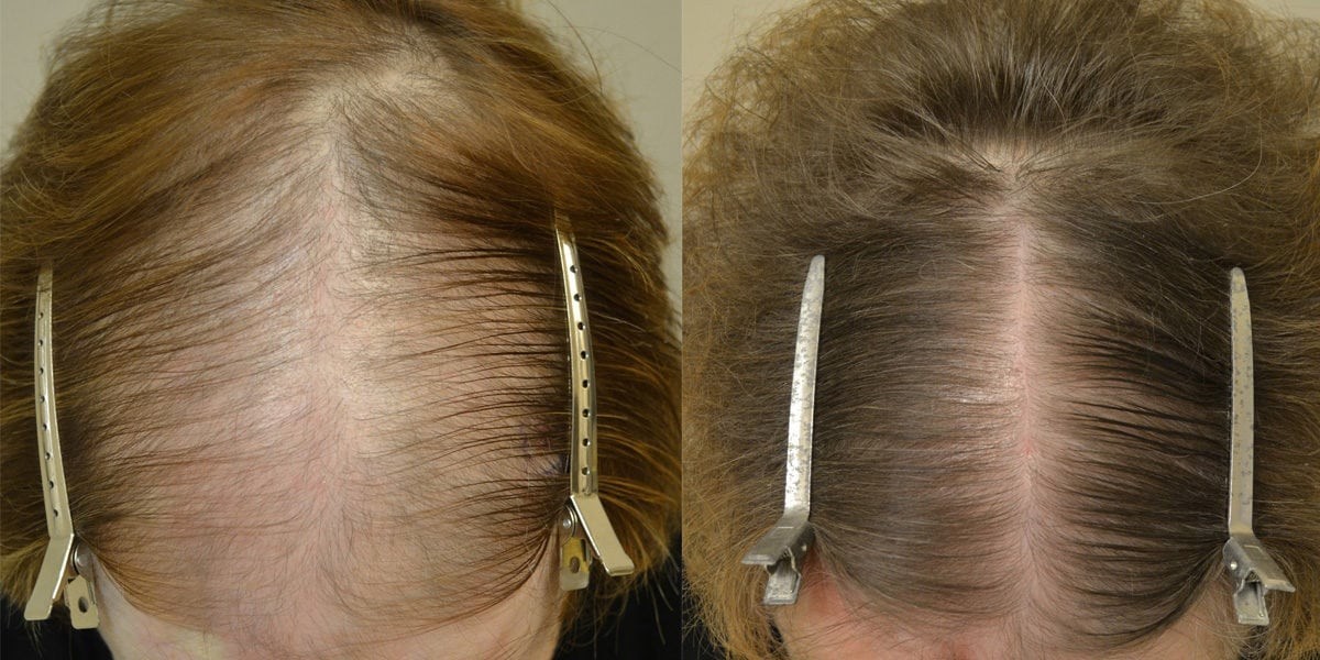 How Finasteride 1mg Price Differs Between Generics and Brand