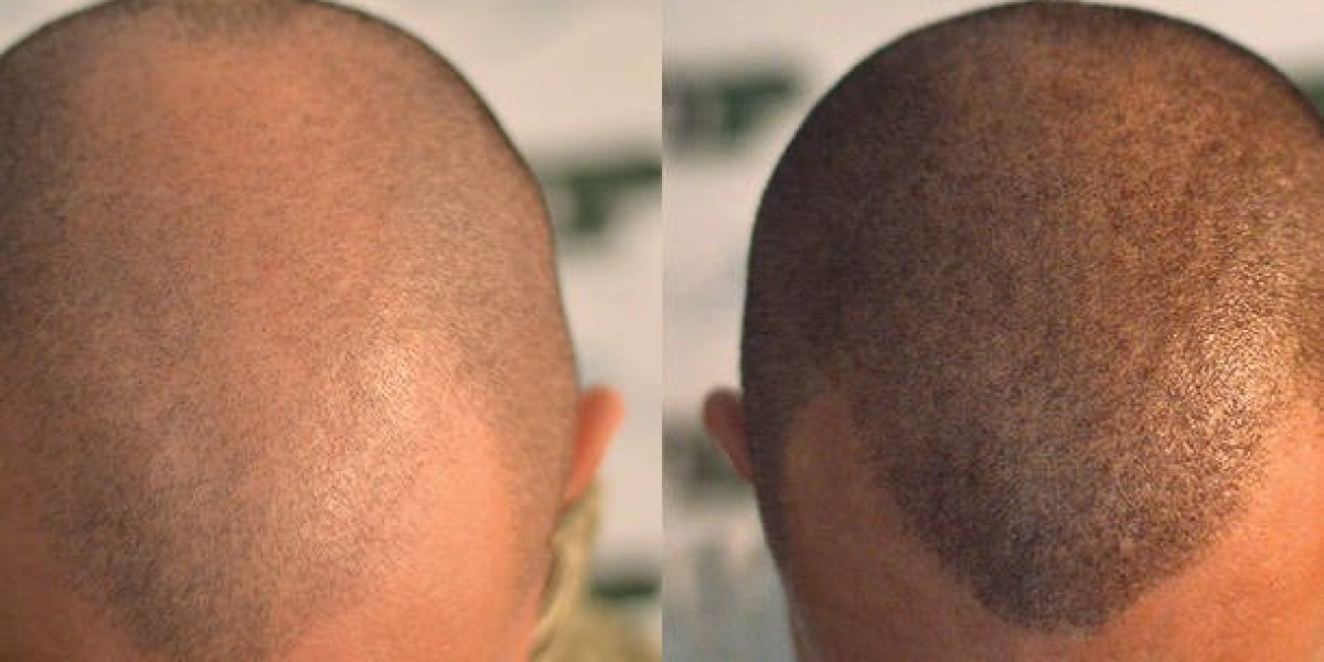 Scalp Micropigmentation in Islamabad for Baldness and Thinning Hair