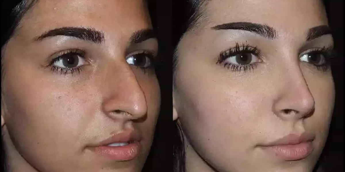Best Septoplasty Surgeons in Dubai Offering Personalized Treatment Plans