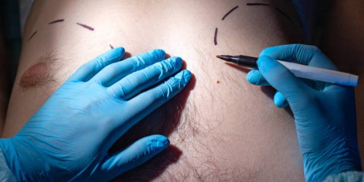 Professional Gynecomastia Treatment for Men in Islamabad