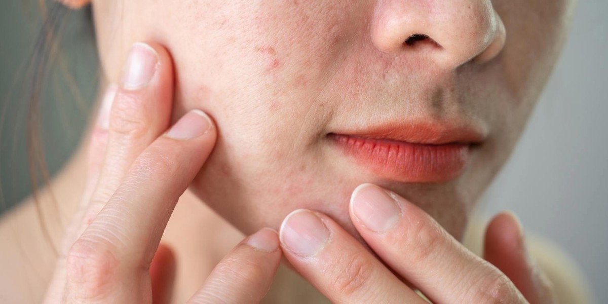 Looking for gentle pimples treatment?