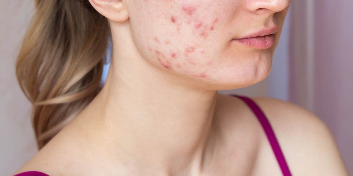 Experience Clear Skin Confidence with Acne Treatment Dubai