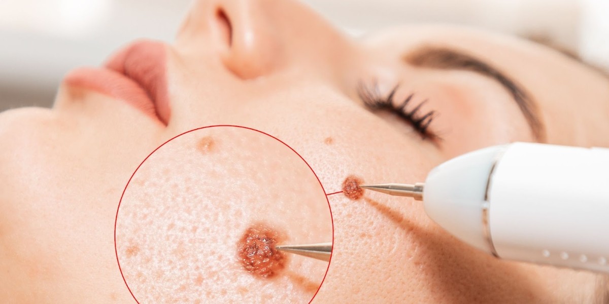 Painless Mole and Skin Tag Removal in Dubai: What to Expect