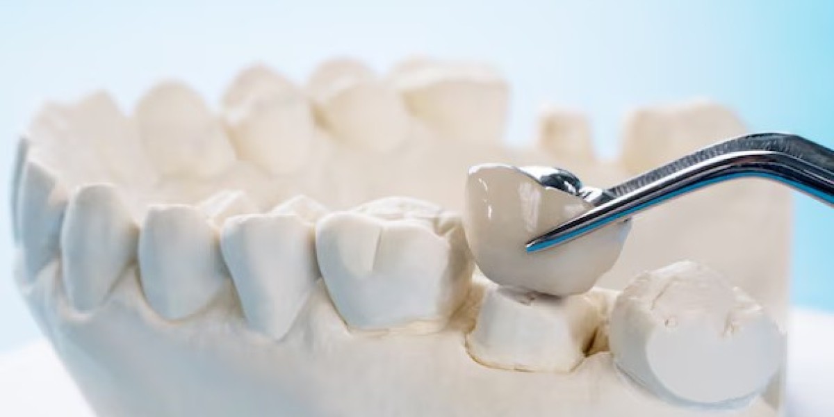 Prevent Shifting Teeth with Dental Bridges: A Comprehensive Guide Permanent Solution for Missing Teeth