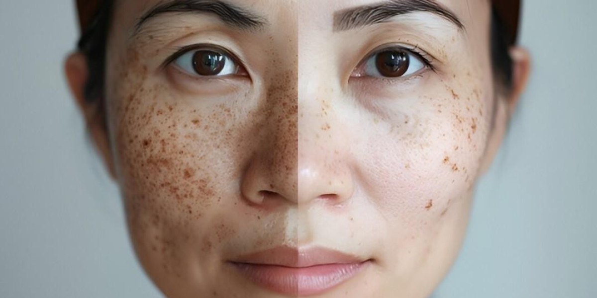 Is Skin Pigmentation in Islamabad Getting Worse?