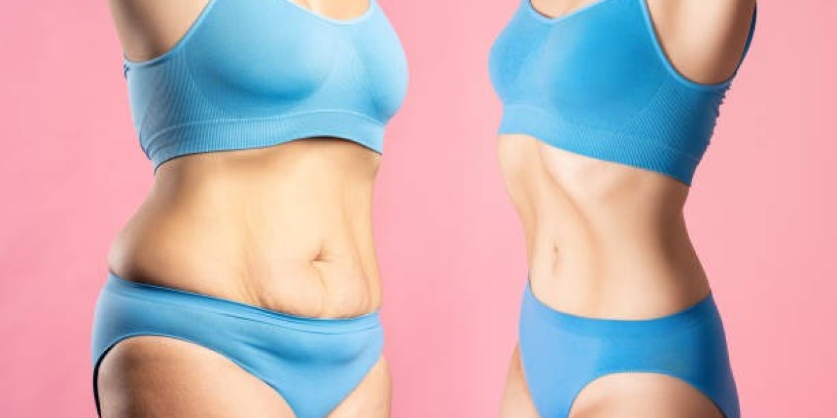 Elevate Self-Esteem Through Liposuction in Riyadh