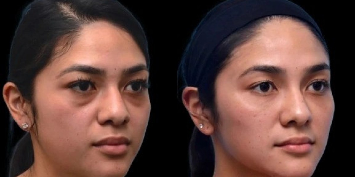 How the Best Doctors in Dubai Combine Treatments for Dark Circles