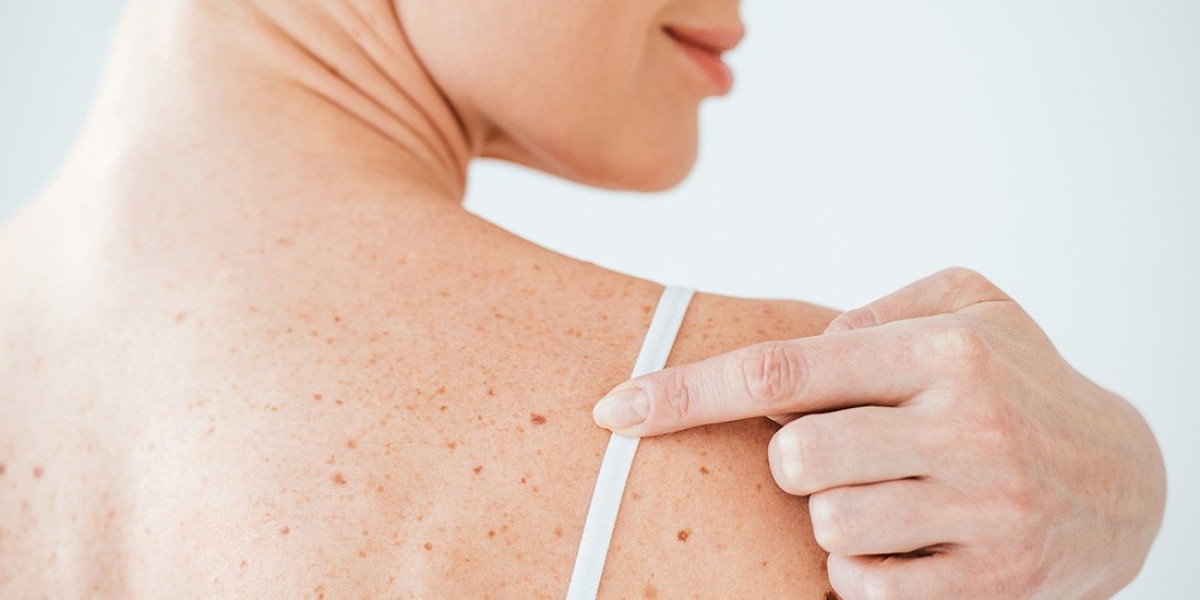 Is Laser Moles Removal Effective?