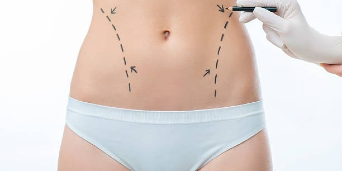 Combining Liposuction with Tummy Tuck: Achieving Comprehensive Contours