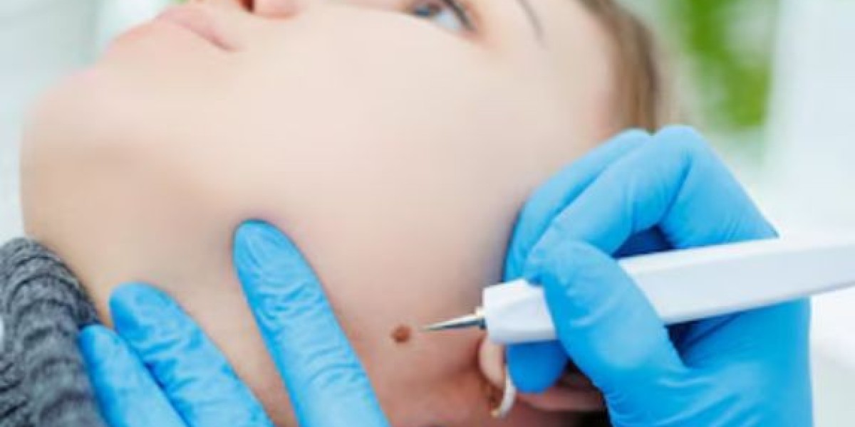 Birthmark Removal in Dubai: A Smarter Way to Treat Skin Marks