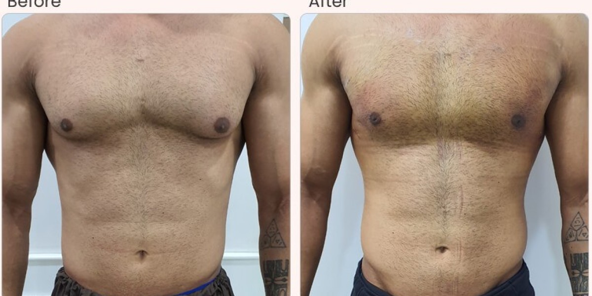 Gynecomastia in Islamabad: Before and After Results