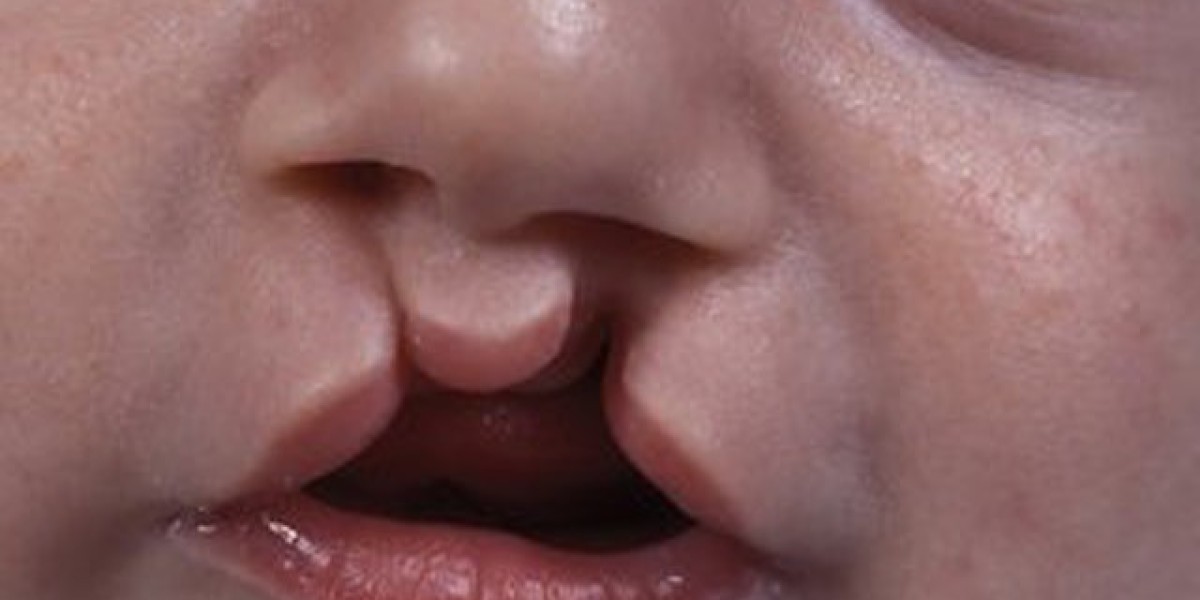 Understanding Cleft Lip Surgery: A Complete Guide in Islamabad