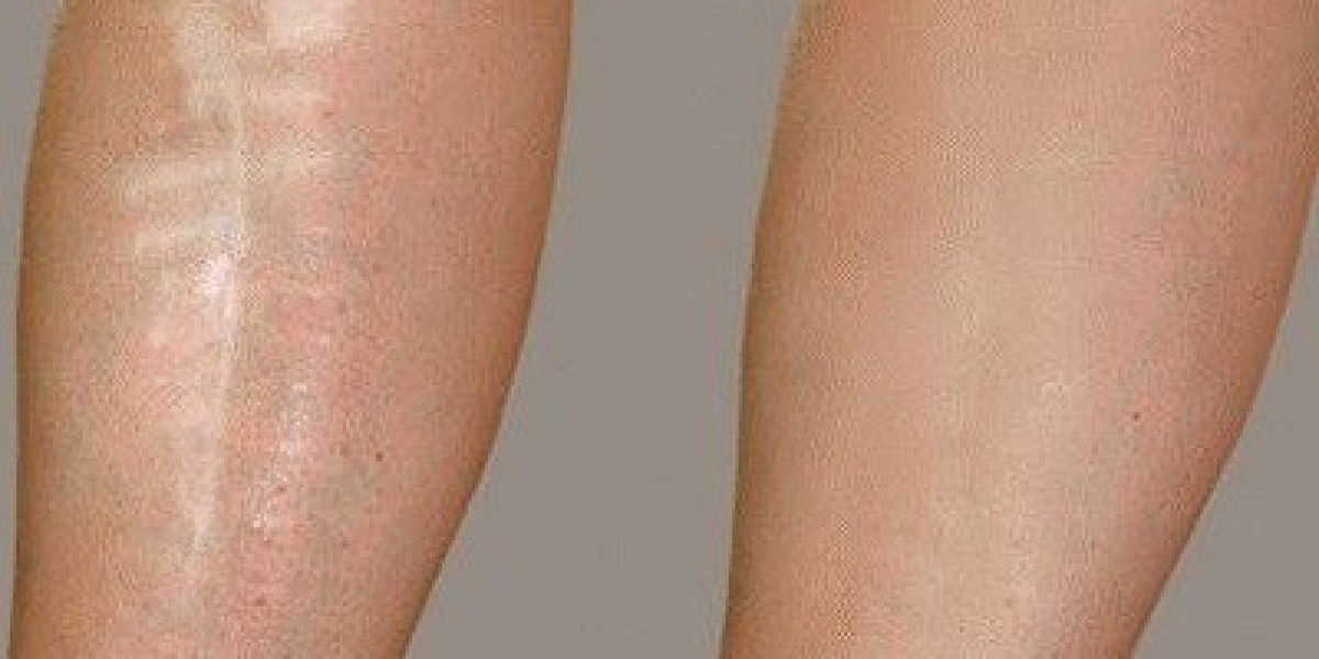 Post-Treatment Care for Scar Removal in Dubai: Essential Tips