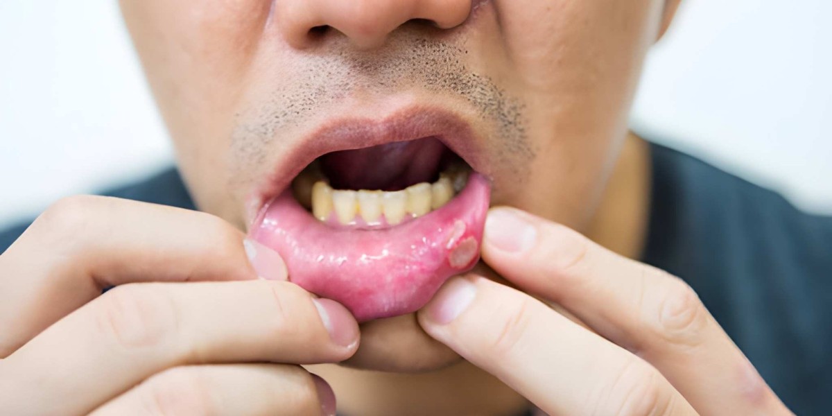 Advancing Solutions to Persistent Challenges in Oral Mucositis Care