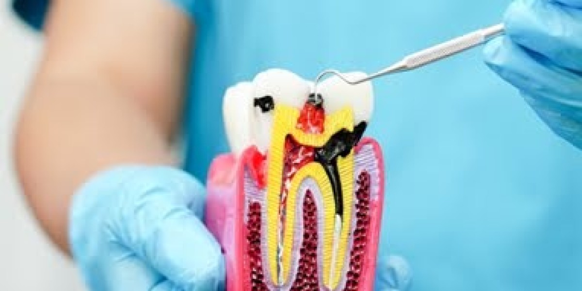 Expert Dental Root Canal Treatment in Pune – Preserve Your Smile Today