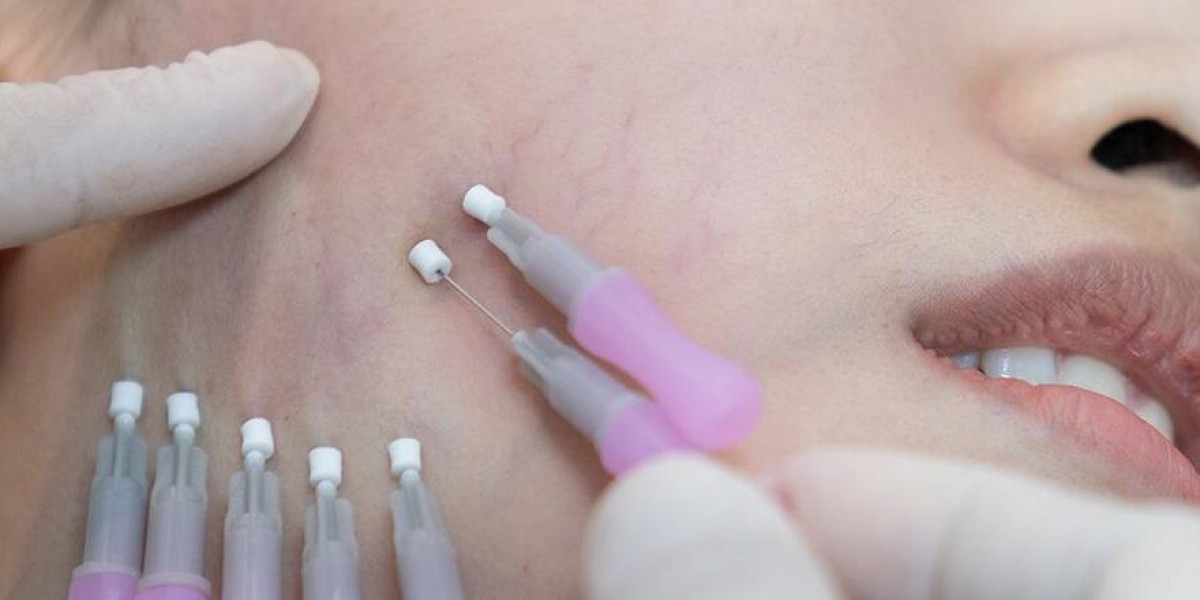 What Makes Sugar Thread Lift Different from Others?