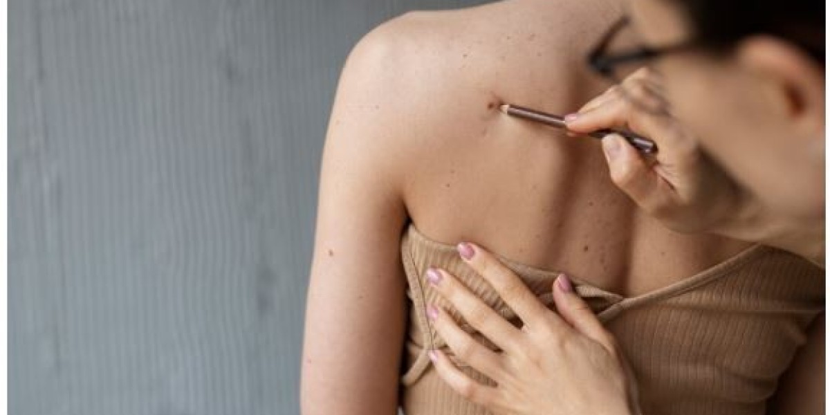 Safe and Effective Methods for Moles Warts Removal That Work Quickly