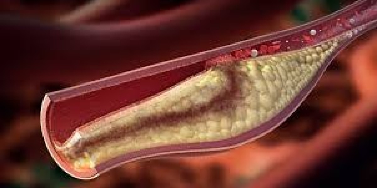 High Cholesterolemia Dubai: Complete Guide to Managing High Cholesterol