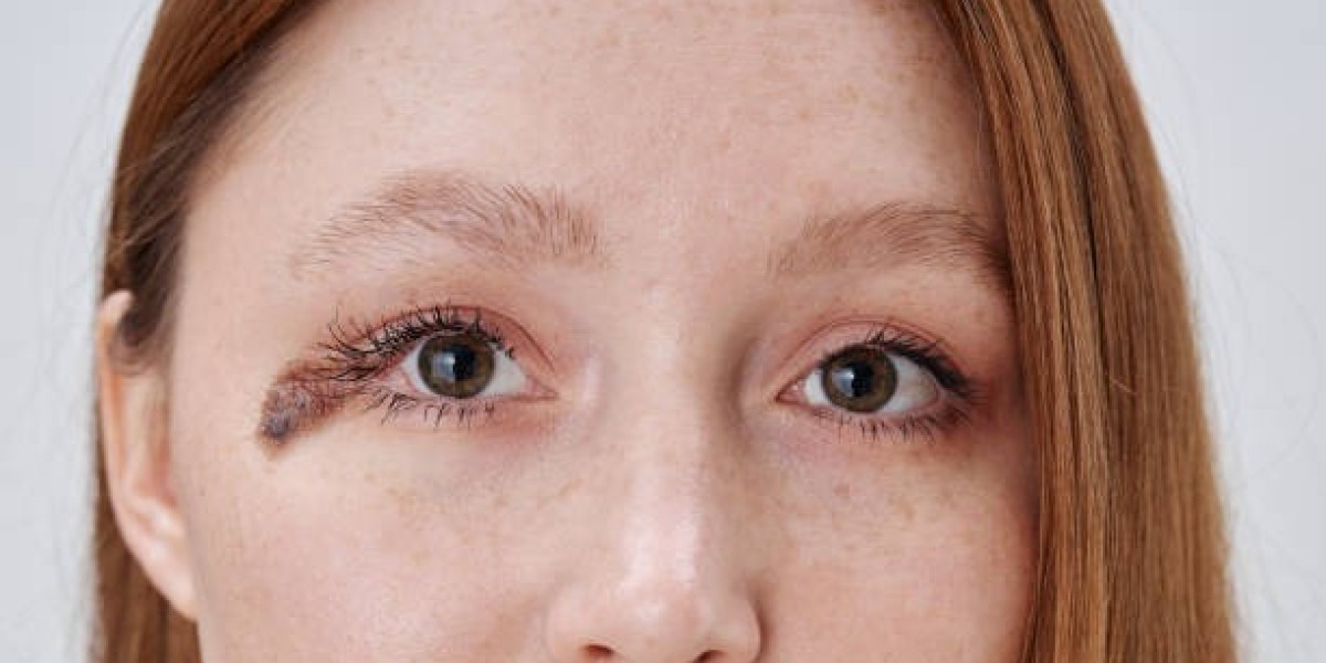 Top-Rated Birthmark Removal in Dubai: Achieve Clear Skin Fast