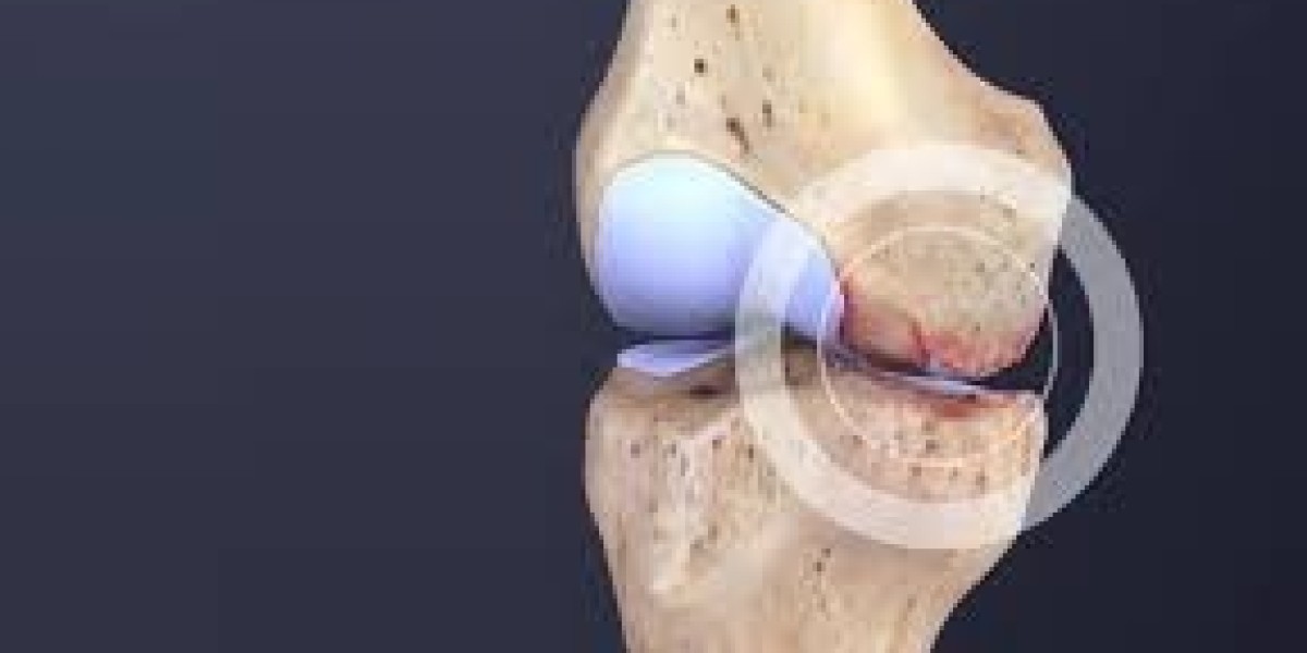 Knee Osteoarthritis Market Share, Clinical Innovation Trends, and Regional Insights: Industry Outlook 2032