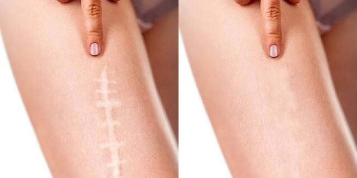 Scar Removal in Dubai: Safe, Effective, and Long-Lasting Treatments