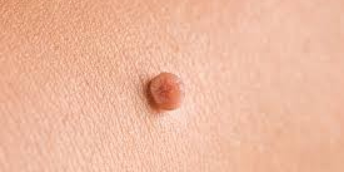 Can Children Safely Undergo Skin Tag Removal?