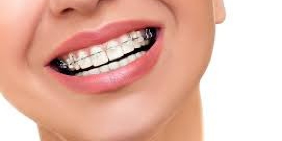 Myths & Facts About Braces Treatment