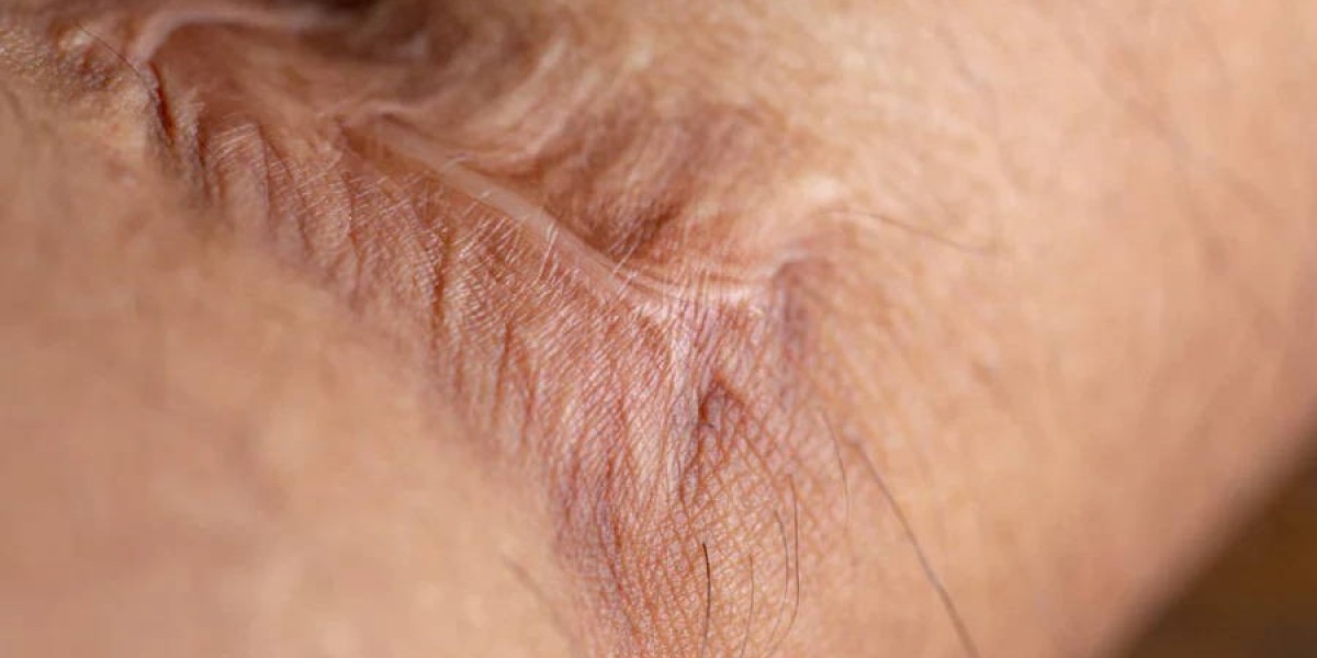 Is Keloid Treatment Suitable for Men and Women?