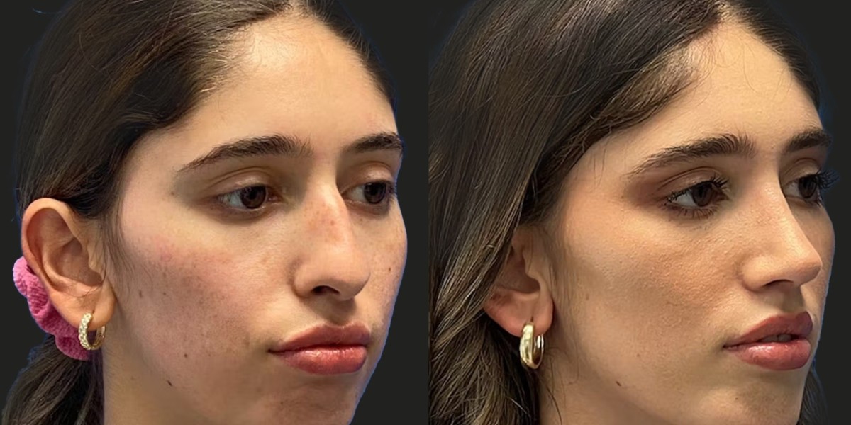 How Chin Augmentation Improves Side Profile and Facial Proportions