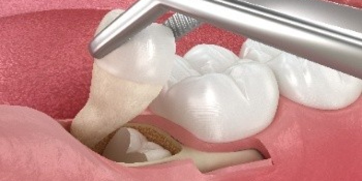 Wisdom Teeth Removal in Pune: Your Complete Guide to Expert Dental Care