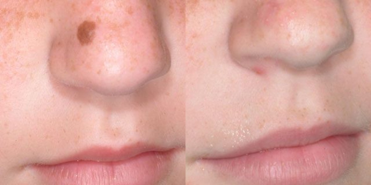 Birthmark removal in Dubai: Separating medical myths from skin reality