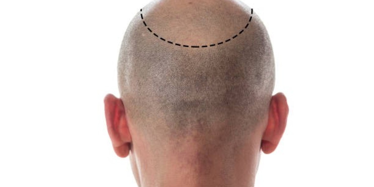 Peptide Injections Post Hair Transplant Growth