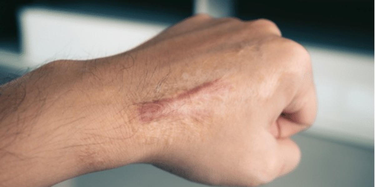 What Is the Average Cost of Hypertrophic Scar Treatment?