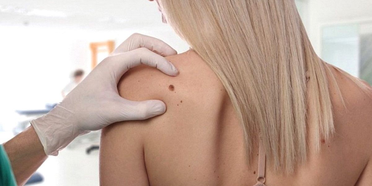 Dermatologist-Approved Warts Removal in Dubai & Abu Dhabi – Glamorous Clinic Dubai