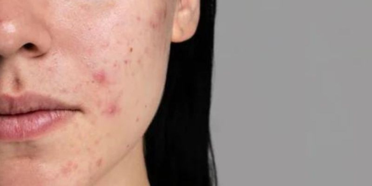 Pimple Treatment in Dubai: Safe, Fast, and Clinically Proven Methods