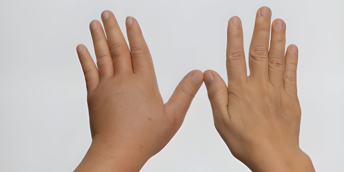 Acrocallosal Syndrome: Genetic Insights, Clinical Features, and Future Outlook