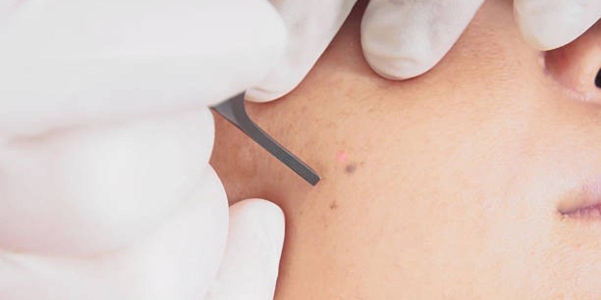 Wart Removal Riyadh: Copper Peptides Healing