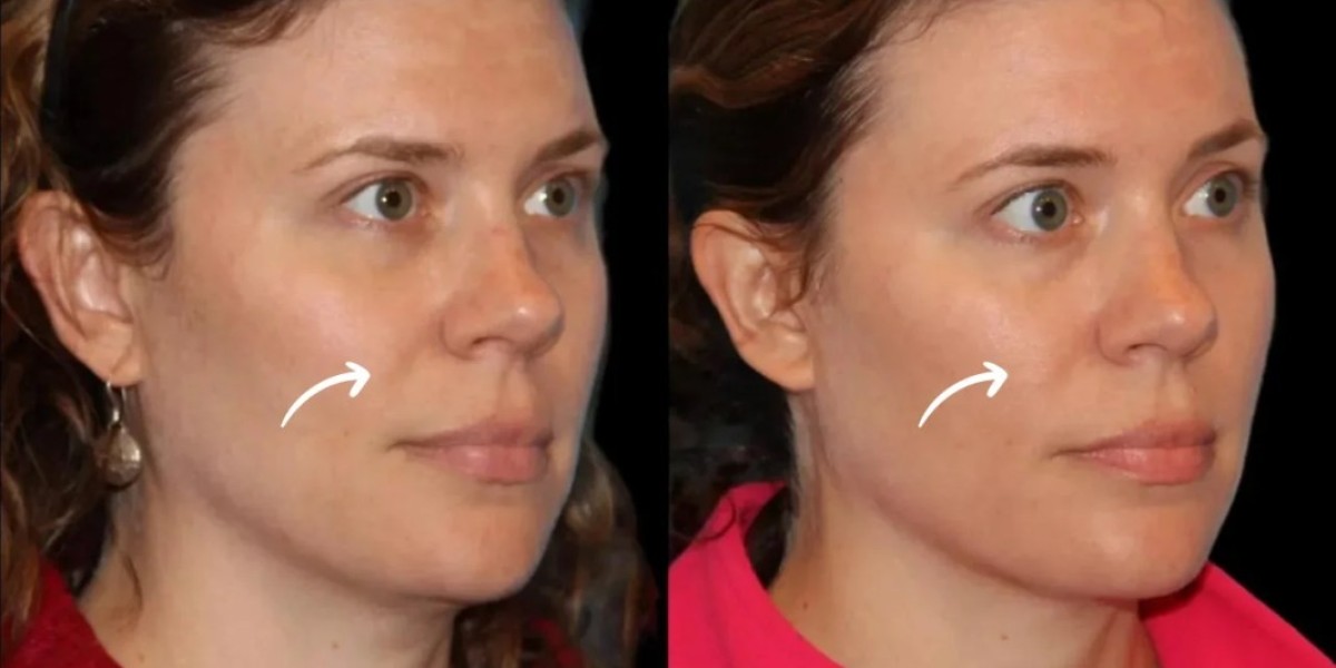Best Doctors in Dubai: Sculptra for Personal Grooming