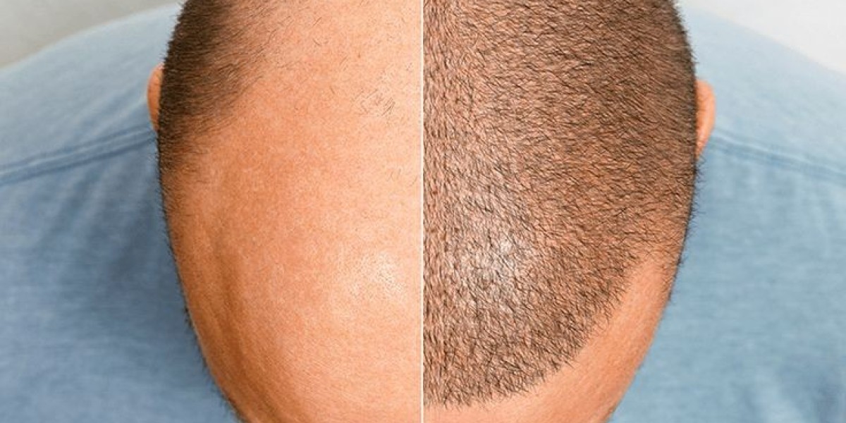 A Patient’s Journey Through Hair Transplant in Sharjah: From Consultation to Results