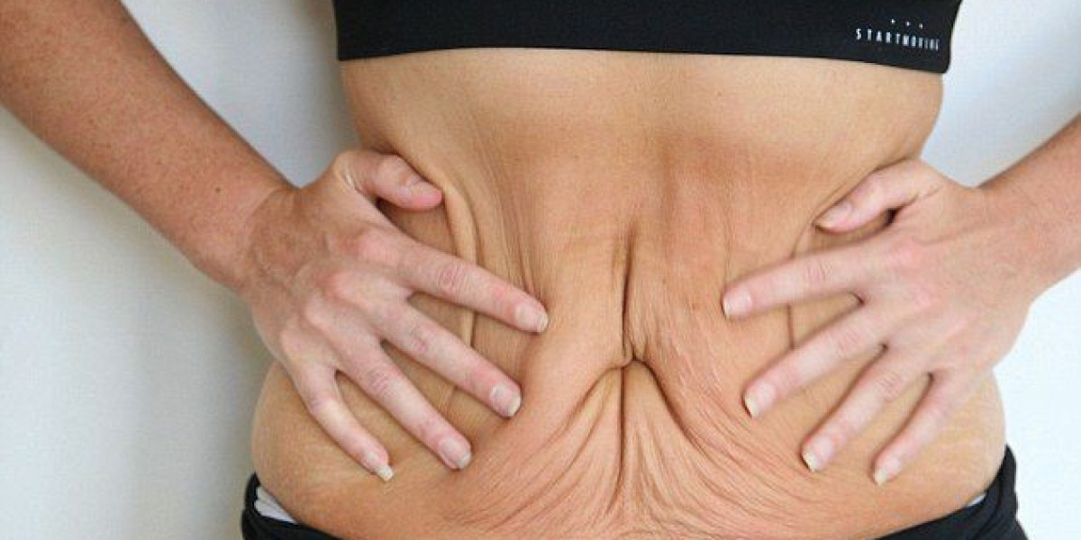 What to Expect During and After a Tummy Tuck in Dubai