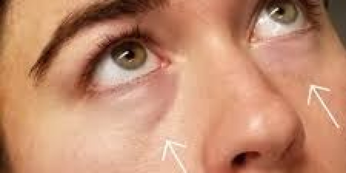 The Dubai Beauty Trend You Can’t Ignore: Powerful Reasons Teosyal Redensity 2 Is Transforming Under-Eye Rejuvenation