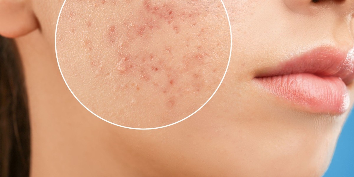 Is Microdermabrasion Effective for Acne Treatment?