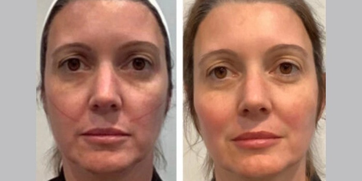 Thread Lift in Dubai Is Trusted For Subtle Elegant Facial Enhancement