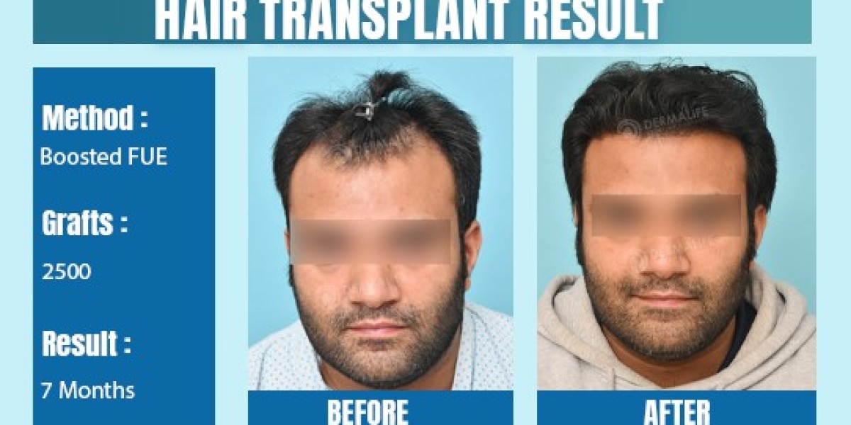 Transparent Hair Transplant Cost in Delhi
